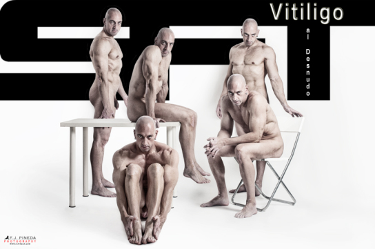 Composición con varias figuras repetidas de un hombre adulto desnudo con vitíligo, dispuestas sobre un fondo de franjas negras y blancas.